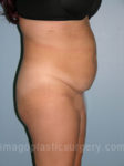 before right side view tummy tuck of female patient 2892