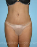after front view tummy tuck of female patient 2892