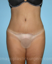 after front view tummy tuck of female patient 2892