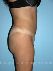 after right side view tummy tuck of female patient 2892