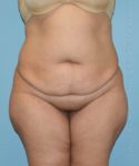 before front view tummy tuck of female patient 2897