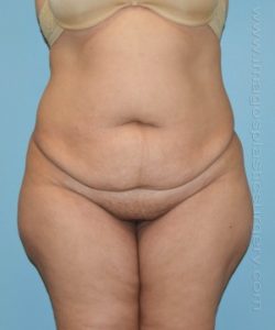 before front view tummy tuck of female patient 2897
