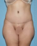 after front view tummy tuck of female patient 2897