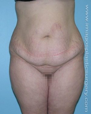 before front view tummy tuck of female patient 2908