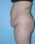 before left side view tummy tuck of female patient 2908