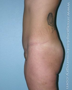after left side view tummy tuck of female patient 2908