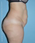 before right side view tummy tuck of female patient 2913