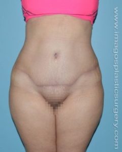 after front view tummy tuck of female patient 2913