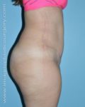 after right side view tummy tuck of female patient 2913
