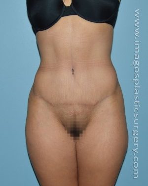 after front view tummy tuck of female patient 2918