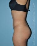 after left side view tummy tuck of female patient 2918