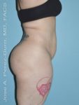 before right side view tummy tuck of female patient 2928