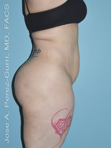 before right side view tummy tuck of female patient 2928