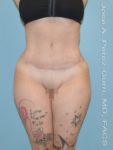 after front view tummy tuck of female patient 2928
