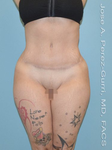 after front view tummy tuck of female patient 2928