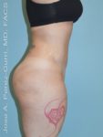 after right side view tummy tuck of female patient 2928