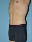 After tummy tuck left side view male patient case 5011