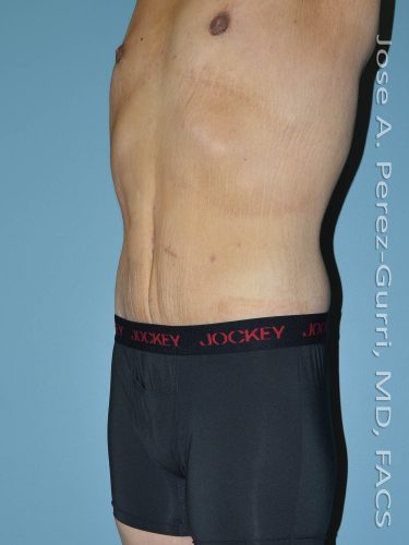 After tummy tuck left side view male patient case 5011