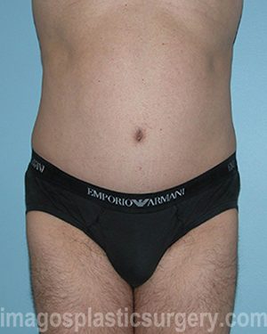 After tummy tuck front view male patient case 5016
