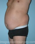 Before tummy tuck left side view male patient case 5016