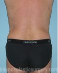 After tummy tuck back view male patient case 5016
