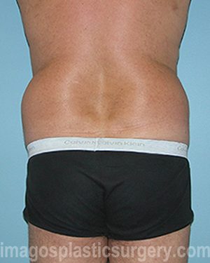 Before tummy tuck back view male patient case 5016
