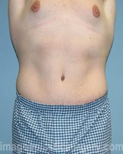 After tummy tuck front view male patient case 5023