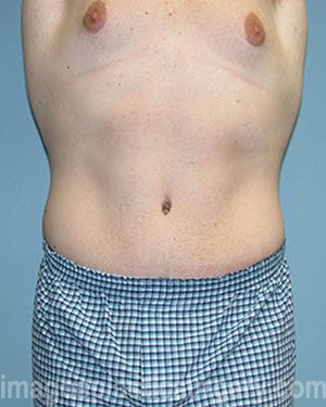 After tummy tuck front view male patient case 5023