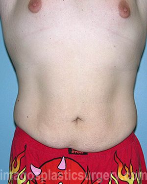 Before tummy tuck front view male patient case 5023