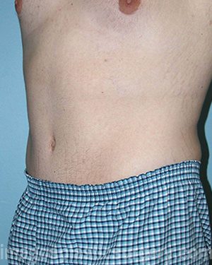 After tummy tuck left side view male patient case 5023