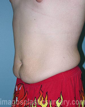 Before tummy tuck left side view male patient case 5023