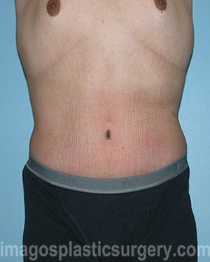 After tummy tuck front view male patient case 5028