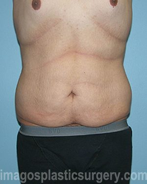 Before tummy tuck front view male patient case 5028