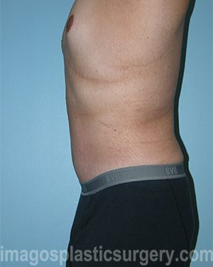 After tummy tuck left side view male patient case 5028