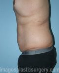 Before tummy tuck left side view male patient case 5028