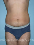 Before tummy tuck front view male patient case 5033