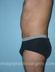 After tummy tuck left side view male patient case 5033