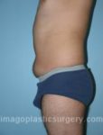 Before tummy tuck left side view male patient case 5033