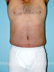 After tummy tuck front view male patient case 5040