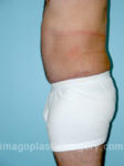 After tummy tuck left side view male patient case 5040