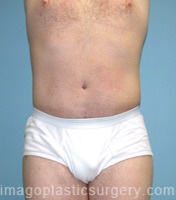 After tummy tuck front view male patient case 5045