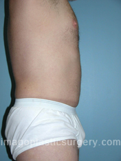 After tummy tuck right side view male patient case 5045
