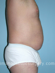 Before tummy tuck right side view male patient case 5045