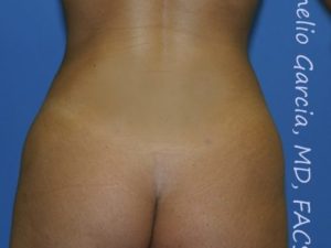 after back view vaser lipo of female patient 3134