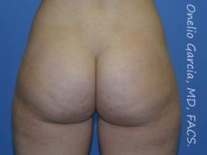 before back view vaser lipo of female patient 3148