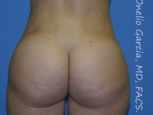 after back view vaser lipo of female patient 3148