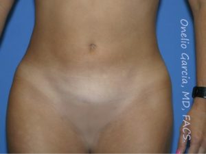 after front view vaser lipo of female patient 3155
