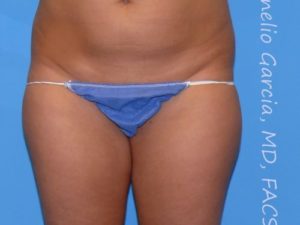 before front view vaser lipo of female patient 3160