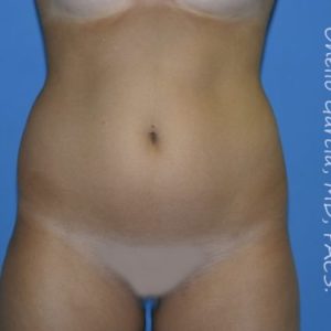 before front view vaser lipo of female patient 3165