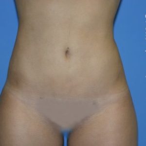 after front view vaser lipo of female patient 3165